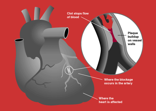 Illustration of Heart Attack Diagram